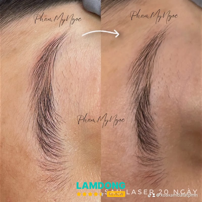 Xoá Xăm Đà Lạt Phạm Mỹ Ngọc – Triệu Việt Vương